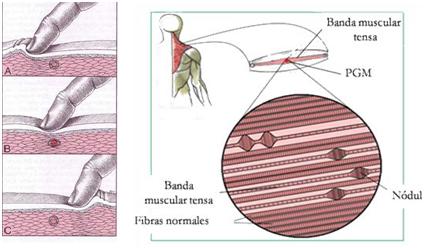 ¿QUÉ ES EL SINDROME DE DOLOR MIOFASCIAL (SDM) Y EN QUÉ CONSISTE LA ...