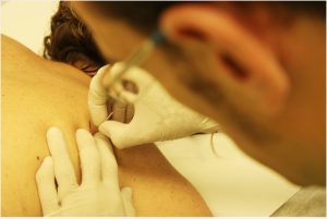 Punción seca en Corpore Fisioterapia