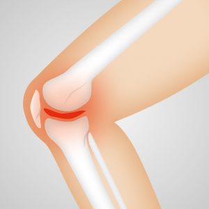 Qué son los meniscos de la rodilla y cuáles son sus lesiones? - Fisiolution