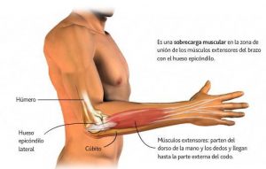 epicondilitis-codo-de-tenista-dolencia