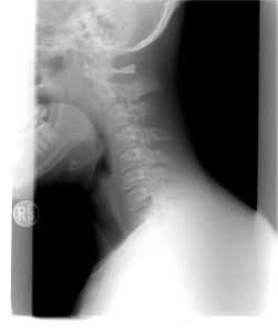 cervical-spine-1129431_1280